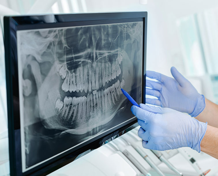 A person wearing gloves is using a blue marker to point at a dental X-ray on a monitor.