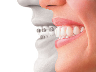 The image shows a split-screen comparison between a person s natural teeth and a set of dental implants, emphasizing the difference in appearance and possibly suggesting improved oral health with the use of dental implants.