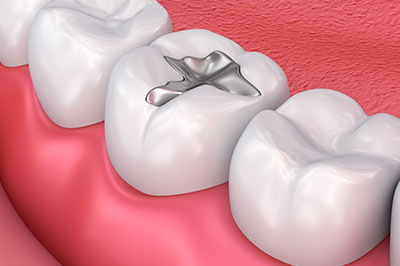 The image shows a close-up view of a dental implant being inserted into a prepared tooth socket within a human mouth, with visible teeth and gum tissue surrounding the area.