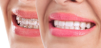 The image shows a woman s face with two different sets of teeth, one on each side, which are likely used for dental implants or cosmetic purposes, displayed against a white background.