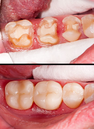 This is a split-image showing a close-up view of a mouth with teeth undergoing dental treatment, likely a cleaning or restoration process, with one side before and the other after the procedure. The images are placed side by side for comparison purposes.