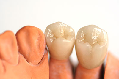 The image shows a row of artificial teeth with varying shades of brown and yellow, placed on a white surface for display or demonstration purposes.