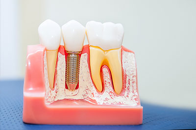 The image shows a dental model with artificial teeth and gums, displaying various dental implants and fixtures inserted into a simulated jaw structure.