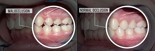 The image shows two photos side by side of a person s teeth before and after a dental procedure, with text overlaying the images explaining  malocclusion  and  normal occlusion.