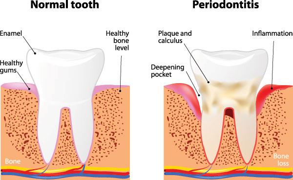 The image depicts three stages of dental decay  normal tooth, early cavity formation, and advanced cavities with visible holes and red inflammation around the teeth.