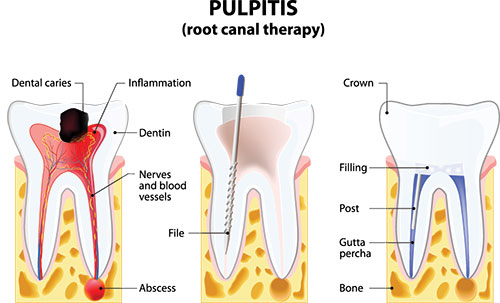 The image shows a diagrammatic illustration of a dental procedure, specifically pulpitis, with annotations pointing out different parts of the tooth and gum structure, including inflammation, infection, and areas affected by the condition.