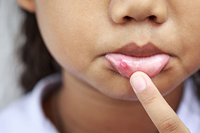 The image shows a close-up view of a person s face with a focus on their lips, which appear to be affected by some sort of irritation or condition, possibly an allergic reaction or lip licking.