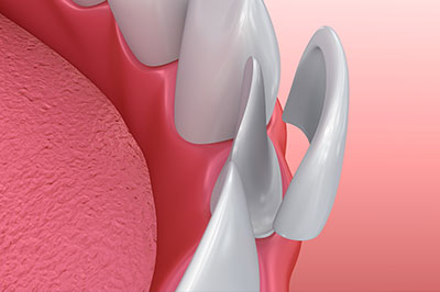 The image shows a close-up view of a dental implant with a screw being inserted into a pink gum area, surrounded by detailed illustrations of teeth and gums.