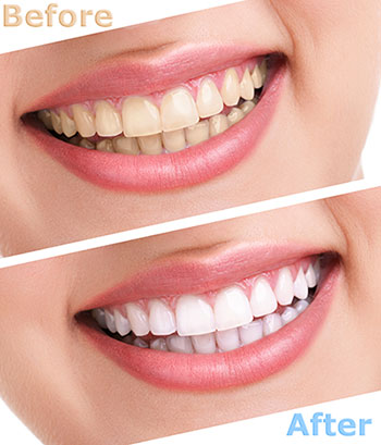 The image shows a woman s smiling face before and after teeth whitening treatment, with a clear difference in tooth color between the two images.