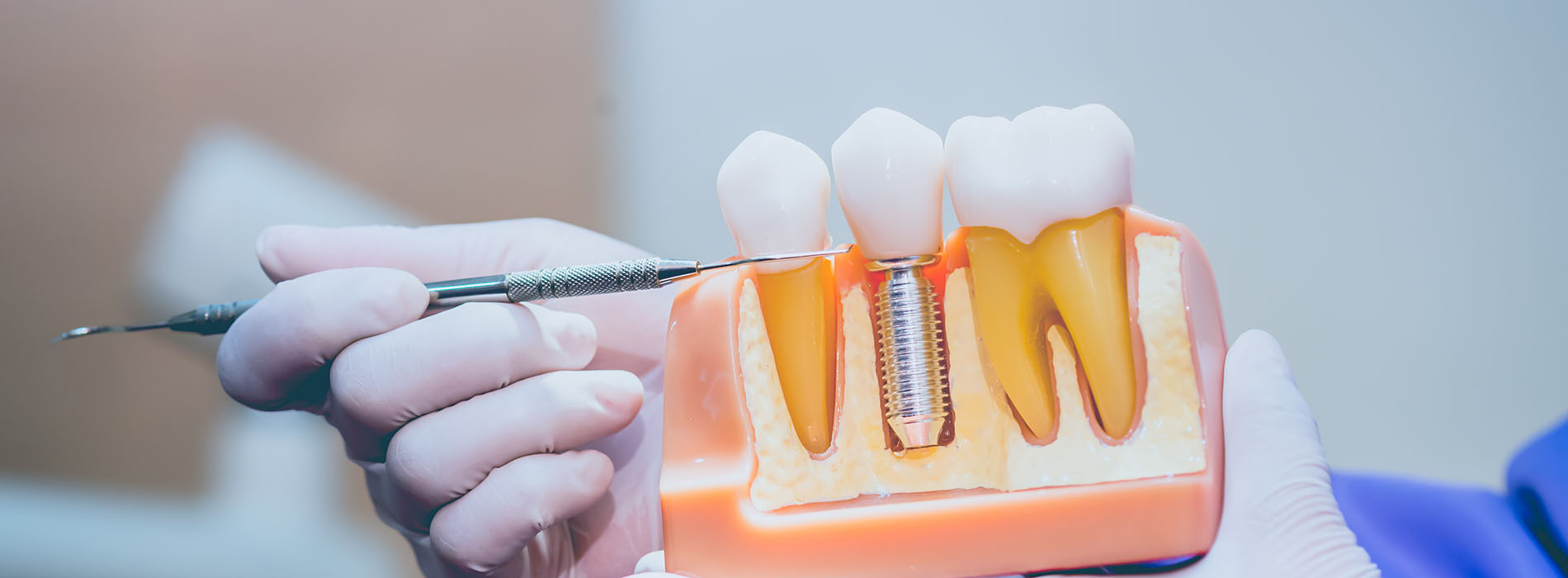 A person holding a dental implant with a screwdriver, demonstrating oral care equipment.