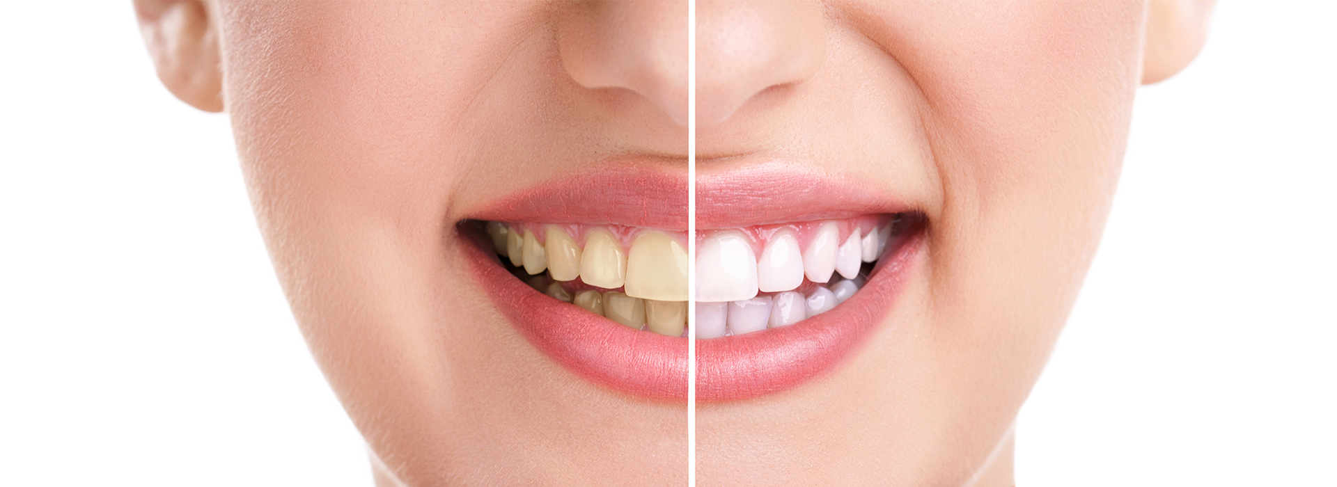 The image features a close-up of a person s face with a focus on their teeth, showcasing a dental treatment process with before and after comparison.