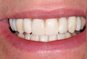 The image shows a close-up view of a person s smile with bright white teeth.