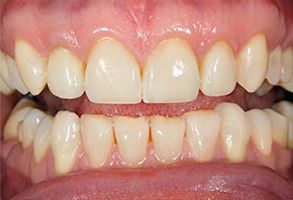 The image shows a close-up of a person s mouth with yellowish teeth and pink gums.