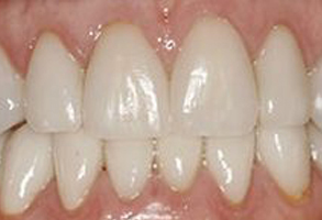 The image shows a close-up view of a person s teeth with visible staining and discoloration.