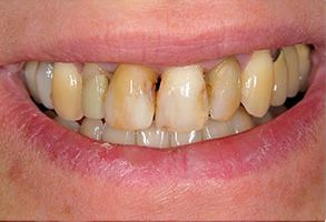 The image depicts a close-up view of a person s teeth showing signs of discoloration and potential decay, with an open smile revealing the condition of their oral health.