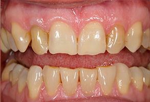 The image shows a close-up view of a person s teeth with an emphasis on oral hygiene, possibly for dental care promotion or educational purposes.
