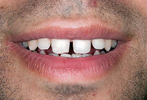 A close-up photograph of a smiling man with an open mouth, revealing teeth and gums, against a white background.