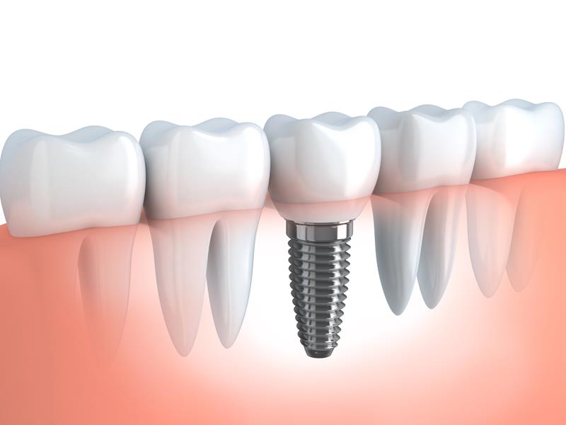 Dental Implants  Savannah, GA 